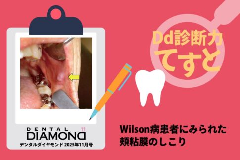 Dd診断力てすと『Wilson病患者にみられた頰粘膜のしこり』デンタルダイヤモンド 2025年11月号