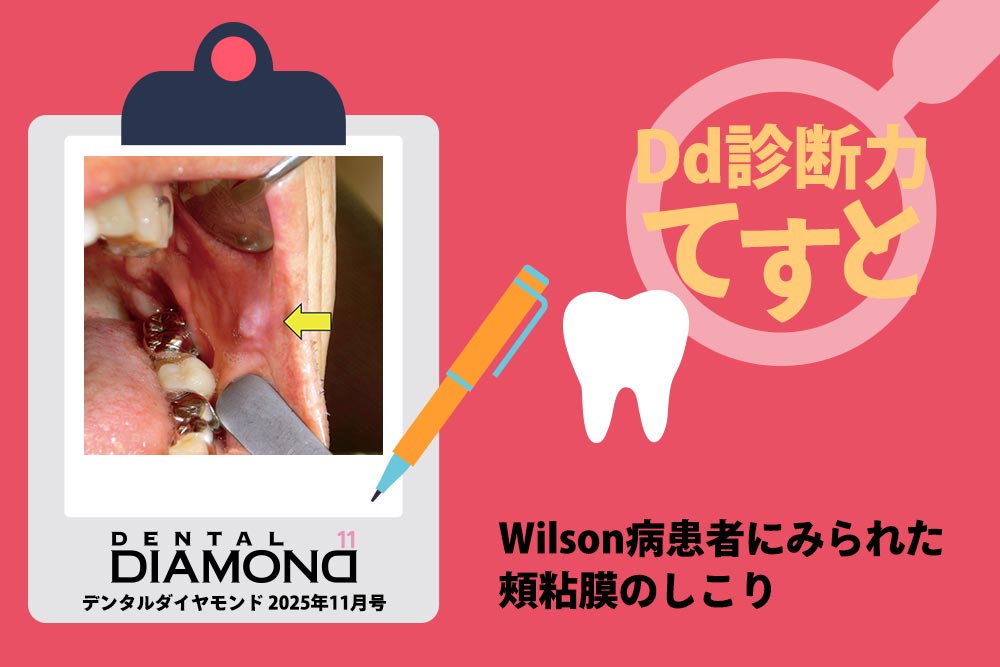 Dd診断力てすと『Wilson病患者にみられた頰粘膜のしこり』デンタルダイヤモンド 2025年11月号