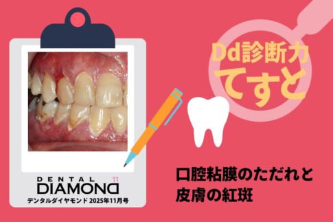 Dd診断力てすと『口腔粘膜のただれと皮膚の紅斑』デンタルダイヤモンド 2025年11月号