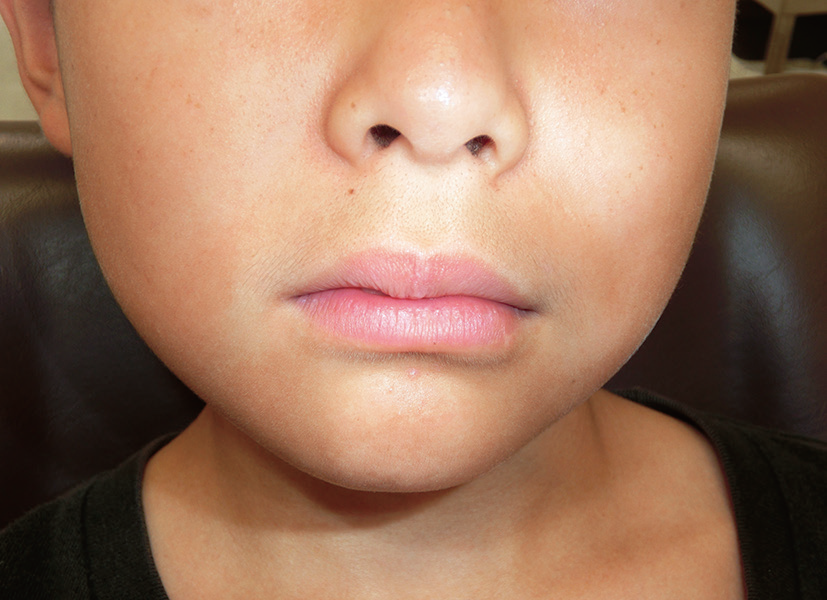 図❶ 初診時の口腔外所見