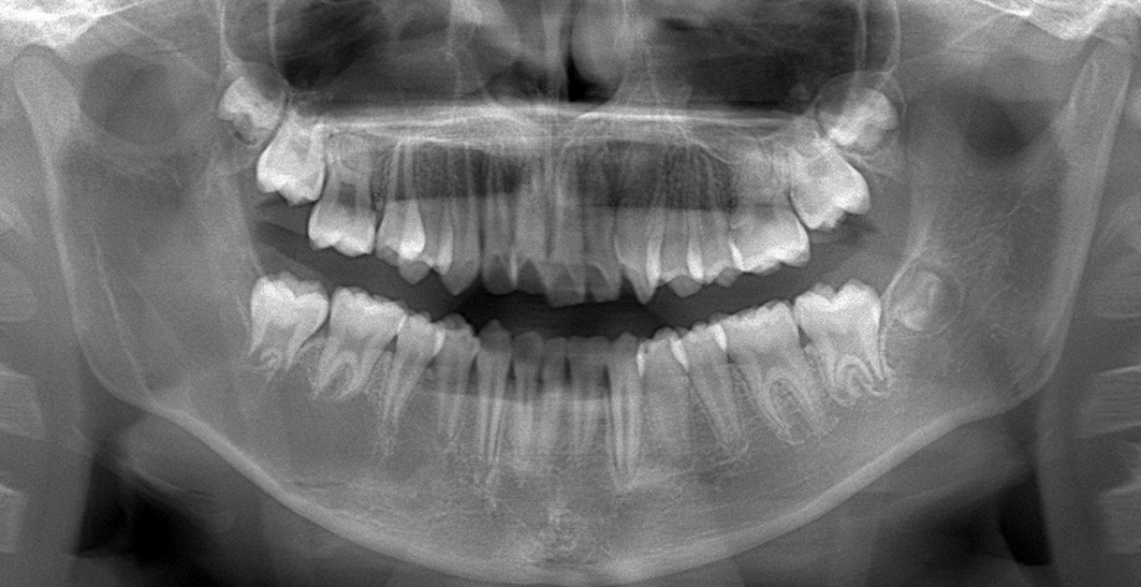 図❷ 初診時のパノラマX線所見