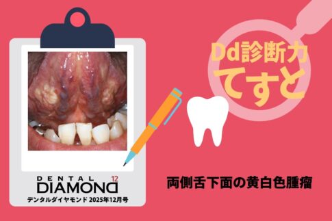 Dd診断力てすと『両側舌下面の黄白色腫瘤』デンタルダイヤモンド 2025年12月号