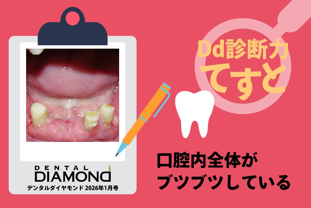 Dd診断力てすと『口腔内全体がブツブツしている』デンタルダイヤモンド 2026年1月号