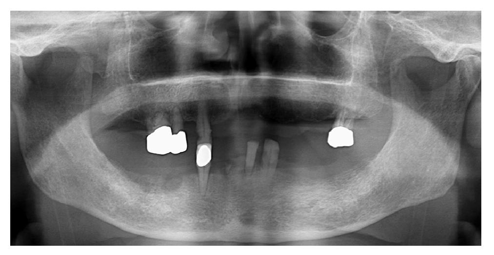 図❷　初診時のパノラマX 線写真