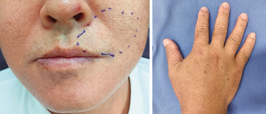 図❶　初診時の顔貌写真および手指写真