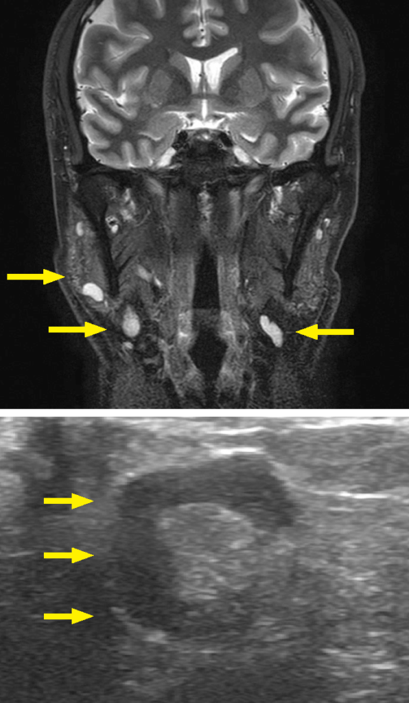 図❷　初診時のMRI 画像および超音波画像