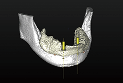 図2 無歯顎症例におけるインプラント埋入計画の立案、およびサージカルガイドをオーダーするCT撮影用ステントとしてよく活用されている
