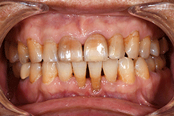 図1 高齢者（70代、男性）の歯。ホワイトニングを希望して来院した
