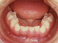 ４歳児のの癒合歯（a）