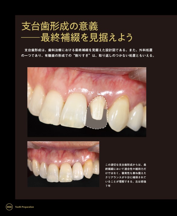 The Basic Planes for Tooth Preparation 支台歯形成の面基準-