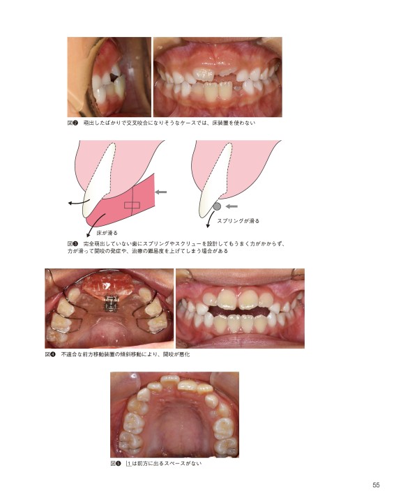 GPのための床矯正治療を成功させる床装置と設計