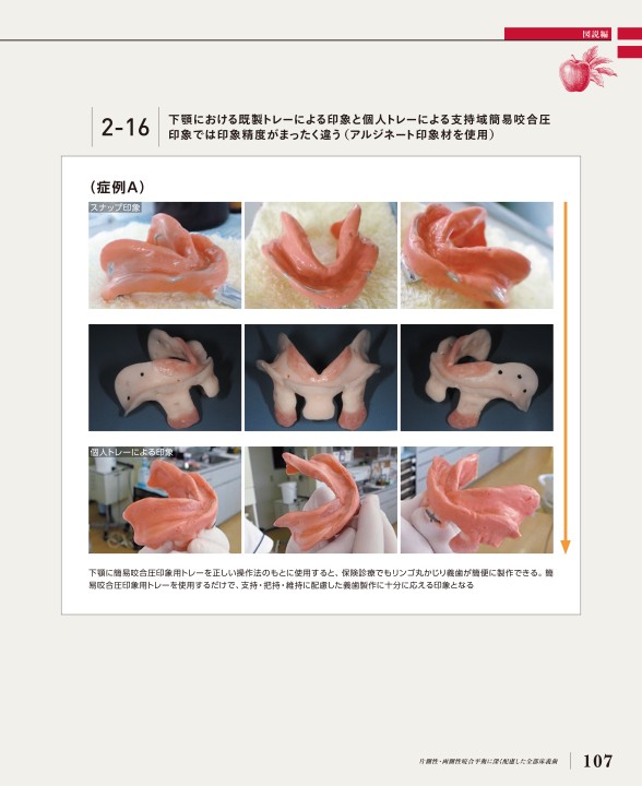 その他 Imai Method Complete Denture Imai Method Complete Denture